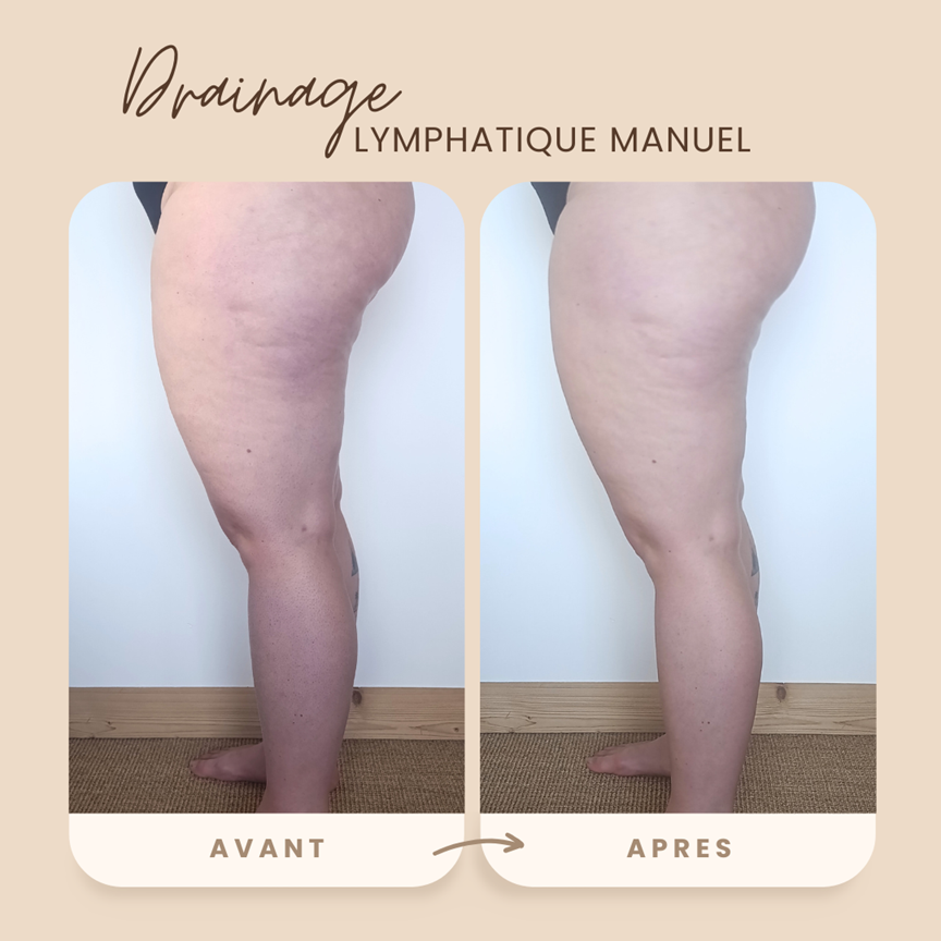 Avant/après d'une séance de drainage lymphatique manuel montrant une diminution visible du volume et de la rétention d'eau au niveau de la jambe.