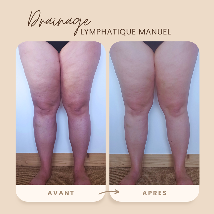 Avant/après d'une séance de drainage lymphatique manuel montrant une diminution visible du volume et de la rétention d'eau au niveau de la jambe.