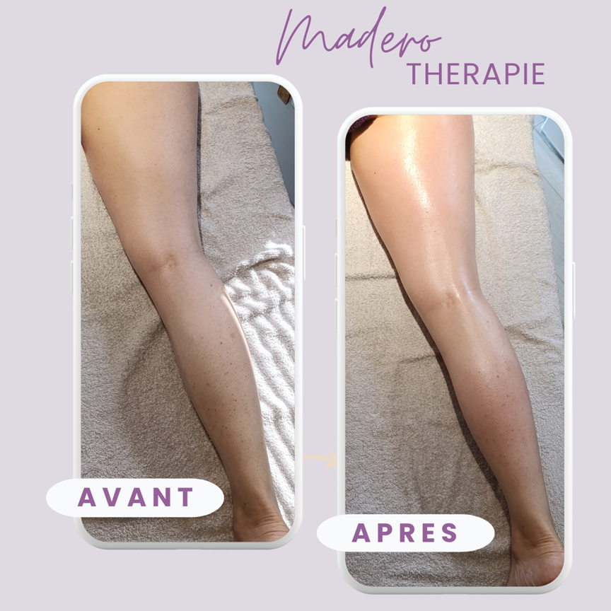 Visuel avant/après, on observe une peau plus lisse, une diminution des capitons et une meilleure tonicité des tissus. Les résultats peuvent varier selon chaque personne, le nombre de séances réalisées et l'hygiène de vie associée.